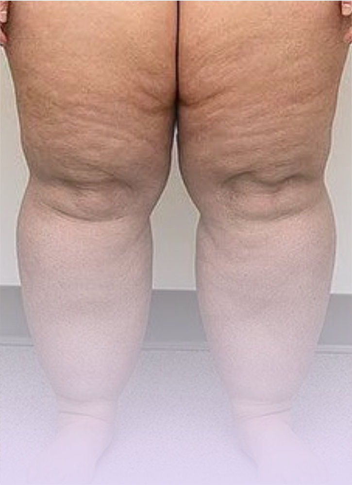 Lipedema 360°